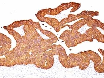 IHC: Formalin-fixed, paraffin-embedded human colon carcinoma stained with EpCAM antibody.~