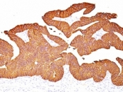 IHC: Formalin-fixed, paraffin-embedded human colon carcinoma stained with EpCAM antibody.