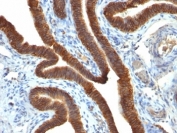 IHC: Formalin-fixed, paraffin-embedded human ovarian carcinoma stained with EpCAM antibody.