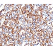 IHC: Formalin-fixed, paraffin-embedded human breast carcinoma stained with EpCAM antibody cocktail (PAN-EpCAM).