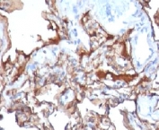 IHC: Formalin-fixed, paraffin-embedded human melanoma stained with MCAM antibody (MCAM/1101)