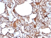 IHC: Formalin-fixed, paraffin-embedded human melanoma stained with anti-CD146 antibody (SPM620)
