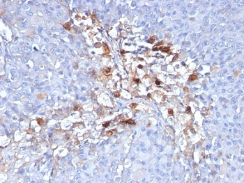 IHC: Formalin-fixed, paraffin-embedded human melanoma stained with CD146 antibody (clone C146/634).~
