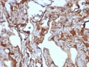 IHC: Formalin-fixed, paraffin-embedded human melanoma stained with CD146 antibody (clone MUC18/1130).