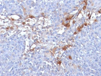 IHC: Formalin-fixed, paraffin-embedded human melanoma stained with CD146 antibody (clone MUC18/1130).~