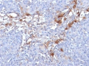 IHC: Formalin-fixed, paraffin-embedded human melanoma stained with CD146 antibody (clone MUC18/1130).