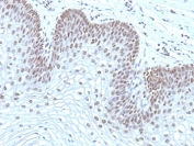 IHC: Formalin-fixed, paraffin-embedded human cervical carcinoma stained with MAP3K1 antibody (2F6).