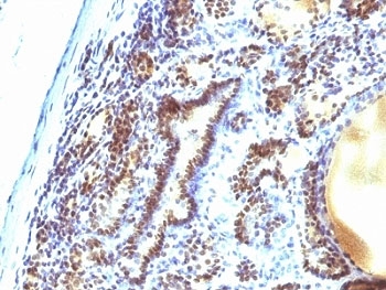 IHC: Formalin-fixed, paraffin-embedded human thyroid carcinoma stained with MAP3K1 antibody (2F6).~