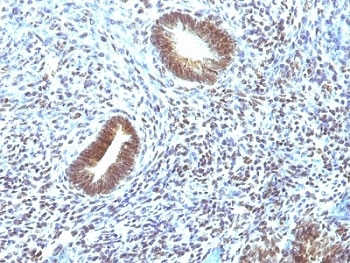 IHC: Formalin-fixed, paraffin-embedded human uterine carcinoma stained with MAP3K1 antibody (2F6).