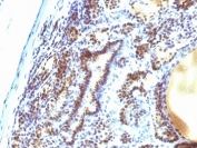 IHC: Formalin-fixed, paraffin-embedded human thyroid carcinoma stained with MAP3K1 antibody (2F6).