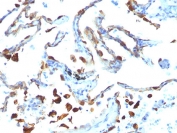 IHC analysis of FFPE human lung carcinoma tested with MFGE8 antibody (MFG-06)