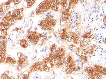 IHC: Formalin-fixed, paraffin-embedded human breast carcinoma stained with MFG-E8 antibody (SPM291)~