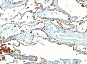 IHC: FFPE human lung carcinoma tested with MFG-E8 antibody (SPM291)