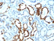 IHC analysis of FFPE human renal cell carcinoma tested with Lactadherin antibody (EDM45)