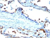 IHC analysis of FFPE human lung carcinoma tested with Lactadherin antibody (EDM45)