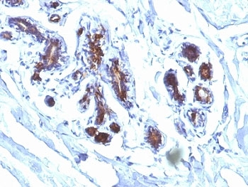 IHC analysis of formalin-fixed, paraffin-embedded human breast carcinoma stained with Lactadherin antibody (EDM45)~
