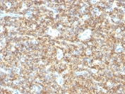 IHC: Formalin-fixed, paraffin-embedded human Ewing's sarcoma stained with CD99 antibody (HO36-1.1).