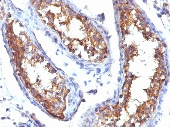 IHC: Formalin-fixed, paraffin-embedded human testicular carcinoma stained with CD99 antibody (HO36-1.1).~