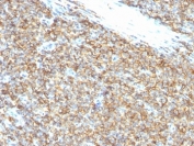 IHC: Formalin-fixed, paraffin-embedded human Ewing's sarcoma stained with CD99 antibody (12E7). Required HIER: boil tissue sections in 10mM Citrate buffer, pH 6.0, for 10-20 min followed by cooling at RT for 20 min.