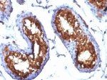 IHC: Formalin-fixed, paraffin-embedded human testicular carcinoma stained with CD99 antibody (clone MIC2/877).