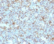 IHC: Formalin-fixed, paraffin-embedded human Ewing's sarcoma stained with CD99 antibody (clone MIC2/877).
