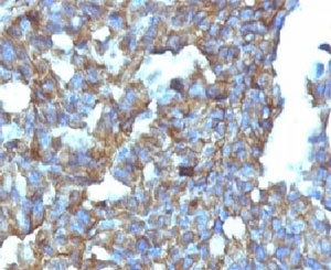 IHC: Formalin-fixed, paraffin-embedded human ovarian carcinoma stained with CD99 antibody (clone MIC2/877).~