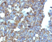 IHC: Formalin-fixed, paraffin-embedded human ovarian carcinoma stained with CD99 antibody (clone MIC2/877).
