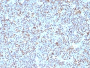 IHC: Formalin-fixed, paraffin-embedded human Ewing's sarcoma stained with anti-CD99 antibody (SPM596).
