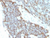 IHC: Formalin-fixed, paraffin-embedded human Ewing's sarcoma stained with CD99 antibody (clones 12E7 + MIC2/877). Required HIER: boil tissue sections in 10mM Citrate buffer, pH 6.0, for 10-20 min followed by cooling at RT for 20 min.