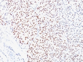 IHC analysis of formalin-fixed, paraffin-embedded human melanoma stained with MITF antibody (clone C5/D5).~