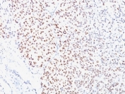 IHC analysis of formalin-fixed, paraffin-embedded human melanoma stained with MITF antibody (clone D5).