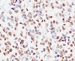 IHC: Formalin-fixed, paraffin-embedded human melanoma stained with MITF antibody (clone MITF/915).~
