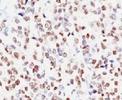IHC: Formalin-fixed, paraffin-embedded human melanoma stained with MITF antibody (clone MITF/915).