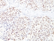 IHC: Formalin-fixed, paraffin-embedded human melanoma stained with MITF antibody cocktail (clones D5 + MITF/915).