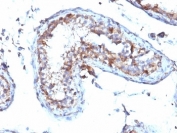 IHC: Formalin-fixed, paraffin-embedded human testicular carcinoma stained with Moesin antibody (MSN/492)