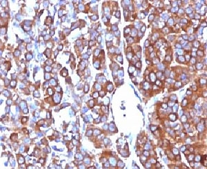 IHC: Formalin-fixed, paraffin-embedded human melanoma stained with Moesin antibody (MSN/492)~