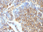 IHC: Formalin-fixed, paraffin-embedded human melanoma stained with Moesin antibody (MSN/493). HIER: boil tissue sections in pH 9 10mM Tris with 1mM EDTA for 20 min and allow to cool before testing.