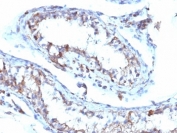 IHC: Formalin-fixed, paraffin-embedded human testicular carcinoma stained with Moesin antibody (MSN/493). HIER: boil tissue sections in pH 9 10mM Tris with 1mM EDTA for 20 min and allow to cool before testing.