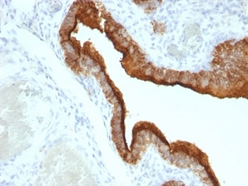 IHC: Formalin-fixed, paraffin-embedded human ovarian carcinoma stained with MUC-1 antibody (clone HMPV).~