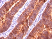 Formalin-fixed, paraffin-embedded human colon carcinoma stained with MUC1 antibody (MUC1/520).