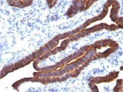 Formalin-fixed, paraffin-embedded human ovarian carcinoma stained with EMA antibody (MUC1/520).