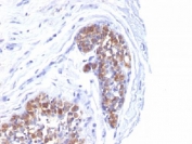 Formalin-fixed, paraffin-embedded human breast carcinoma stained with MUC1 antibody (MUC1/520).