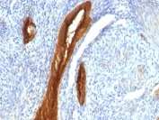 IHC: Formalin-fixed, paraffin-embedded human endometrial carcinoma stained with MUC1 antibody (clone 139H2).