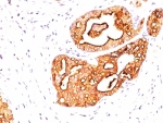 IHC: Formalin-fixed, paraffin-embedded human breast cancer stained with MUC1 antibody (clone 139H2).