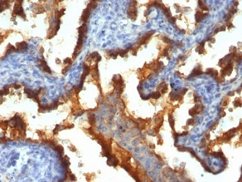 IHC: Formalin-fixed, paraffin-embedded human lung cancer stained with MUC1 antibody (clone 139H2).~