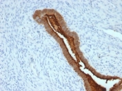 IHC: Formalin-fixed, paraffin-embedded human endometrial carcinoma stained with anti-MUC-1 antibody (clone SPM492).