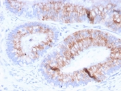 IHC: Formalin-fixed, paraffin-embedded human colon carcinoma stained with MUC2 antibody (clone MLP/842).