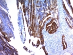 IHC: Formalin-fixed, paraffin-embedded human colon carcinoma stained with MUC2 antibody (clone MLP/842).