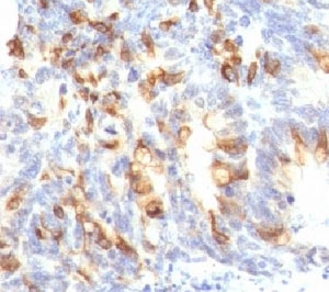IHC: Formalin-fixed, paraffin-embedded human colon carcinoma stained with MUC2 antibody (clone MLP/842).~