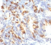 IHC: Formalin-fixed, paraffin-embedded human colon carcinoma stained with MUC2 antibody (clone MLP/842).